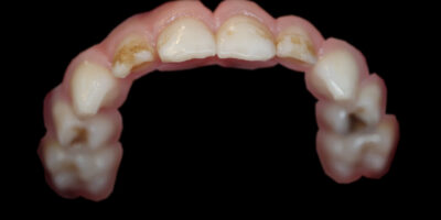 Zubní kaz : mléčné řezáky a čtyřky