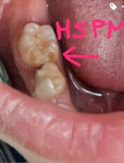 HSPM (Hypomineralised Second Primary Molars)