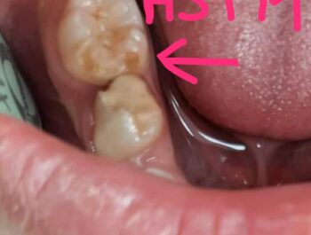 HSPM (Hypomineralised Second Primary Molars)