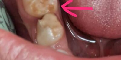 HSPM (Hypomineralised Second Primary Molars)