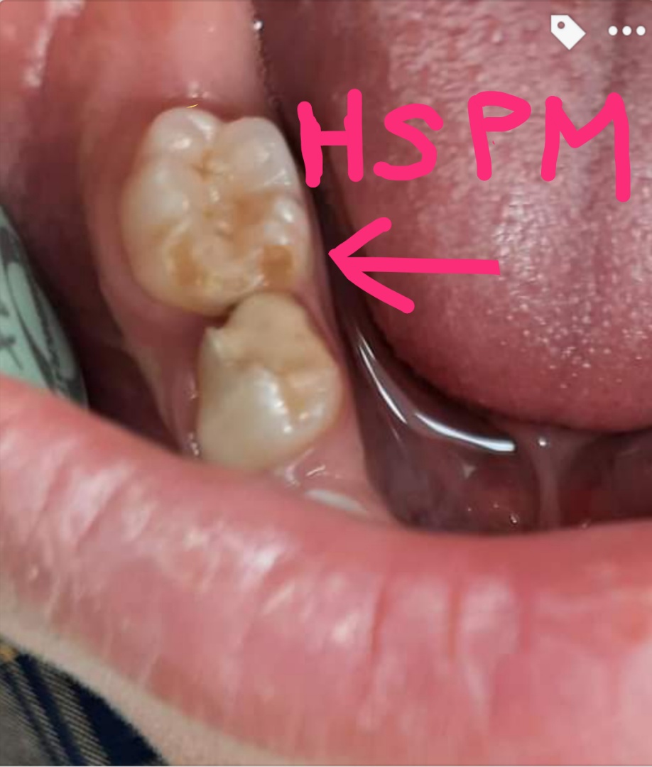 HSPM (Hypomineralised Second Primary Molars)