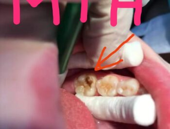 MIH ( Molar Incisor Hypomineralisation)