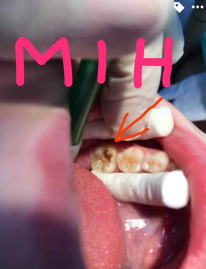 MIH ( Molar Incisor Hypomineralisation)